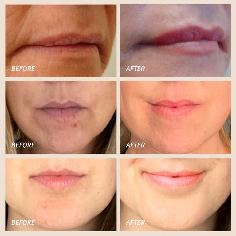 Red Light Therapy For Lips