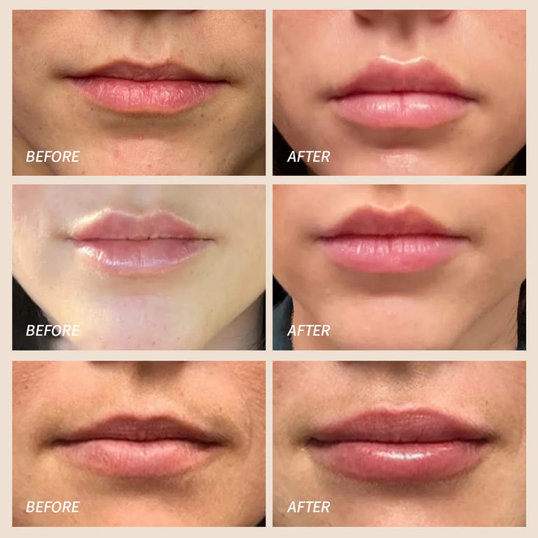 Red Light Therapy For Lips